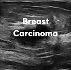 Breast Carcinoma