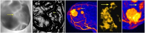Figure 6. STI visualized cluster of three malignant tumors compared to MRI image. Arrow points to smallest tumor, which measured approximately 1.5 mm in pathological examination.